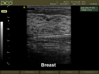 Breast - norm, B-mode