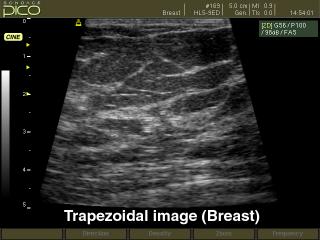 Breast, trapezoidal B-mode