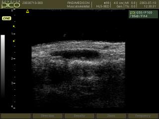 Ganglion, B-mode