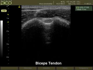 Biceps tendon, B-mode