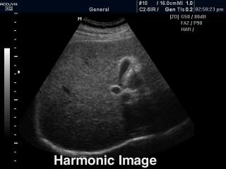 Liver, tissue harmonic