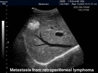 Liver - metastasis from retroperitoneal lymphoma, B-mode