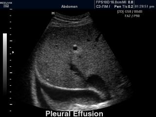 Pleural effusion, B-mode