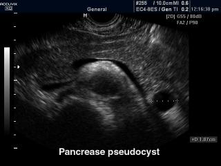 Pancrease pseudocyst, B-mode