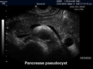 Pancrease pseudocyst, B-mode
