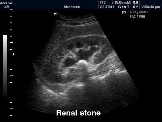 Renal stone, B-mode