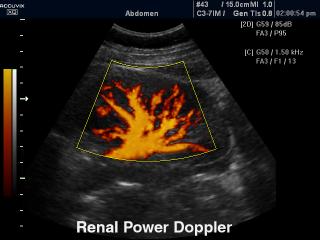 Kidney, power doppler