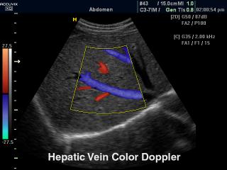 Hepatic vein, color doppler