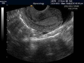 Uterus, B-mode