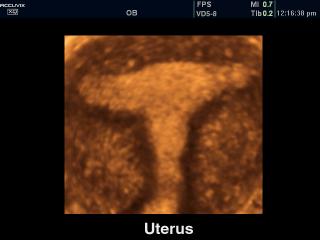 Uterus, 3D