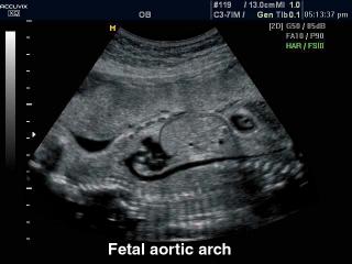 Fetus - arotic arch, B-mode