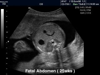 Fetal abdomen - 25 weeks, B-mode