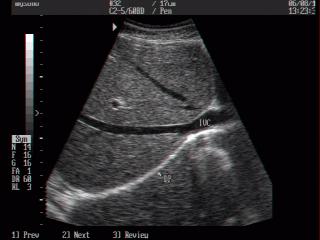 Inferior vena cava, B-mode