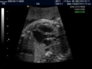 Fetal heart (5 chamber view), B-mode