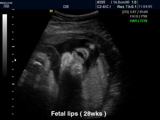 Fetal lips - 28 weeks, B-mode