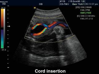 Umbilical cord insertion, color doppler