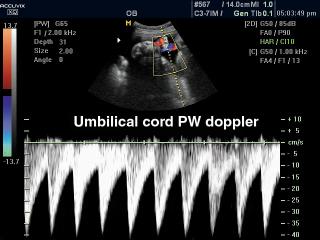 Umbilical cord, CFM & PW