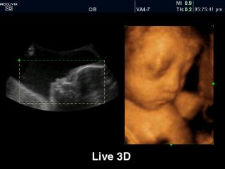 Fetus, Live 3D