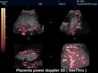 Placenta, power doppler, 3D