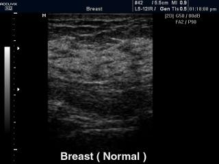 Breast - norm, B-mode