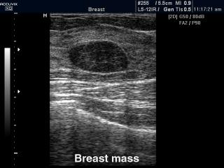 Breast nodule, B-mode