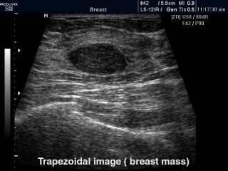 Breast nodule, trapezoidal mode