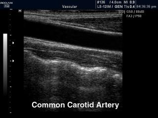 Common carotid artery, B-mode