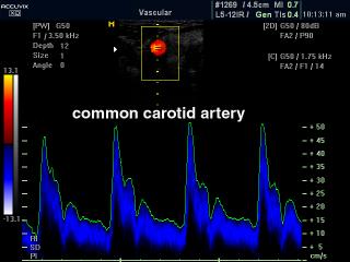 Common carotid artery, CFM & PW
