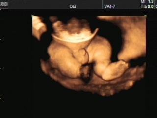 Risomesomelia - defect of fetal`s development, 3D