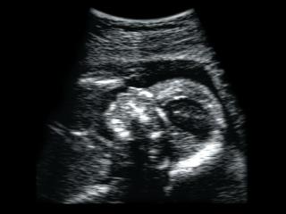 Fetal head, B-mode