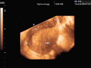 Myometrium