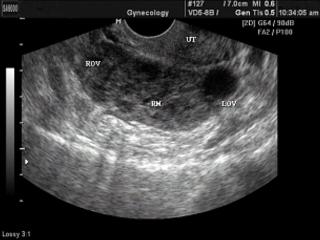 Ectopic pregnancy, B-mode