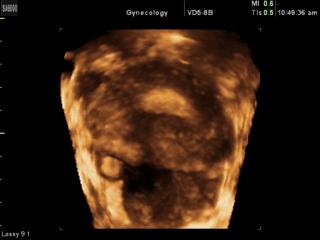 Ectopic pregnancy, 3D