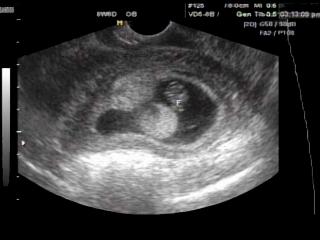 Uterus - subchorionic bleeding, B-mode