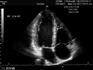 Heart (4 chamber view), B-mode