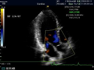 Mitral valve regurgitation, color doppler