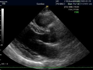 Heart - fundamental harmonic, B-mode