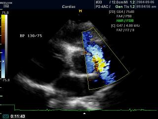 Pulmanic artery, color doppler