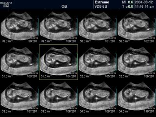 Fetus - nuchal translucency, MSV