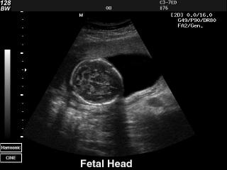 Fetal head, B-mode