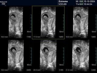 Bicornate uterus, MSV