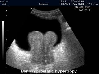 Benign prostatic hypertrophy, B-mode