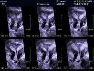 Bicornate uterus, MSV