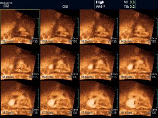 Fetus - cleft lip, MSV
