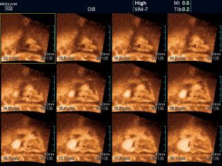 Fetus - cleft lip, MSV