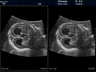 Fetal brain - expansion of the lateral ventricles, MR