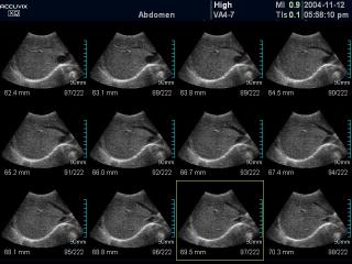 Liver, MSV