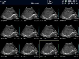 Liver, MSV