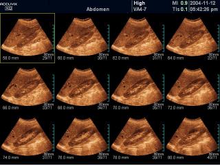 Kidney, MSV
