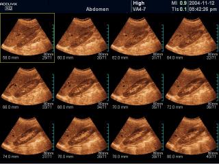 Kidney, MSV